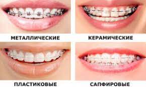 пластины для выравнивания зубов